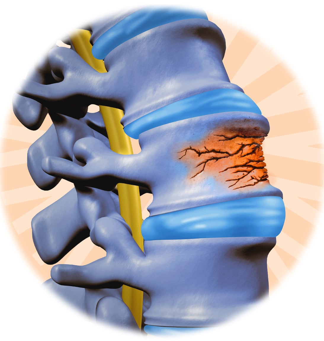 Medical illustration of a vertebrae experiencing compression fractures. The compression fractures are highlighted in orange in comparison to the healthy ones.